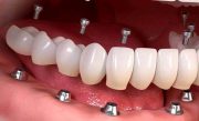  کاشت دندان چیست؟